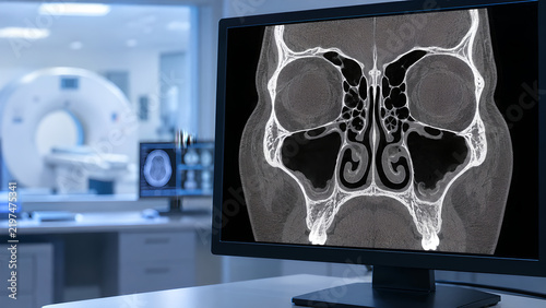 Paranasal sinus CT radiology concept showing early-stage sinusitis with subtle mucosal thickening in realistic medical imaging for healthcare websites, diagnostic education, and patient awareness