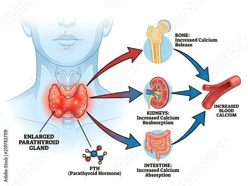 Hyperparathyroidism Medical Infographic Showing PTH Pathway Bone Resorption Kidney Reabsorption and Increased Blood Calcium Diagram