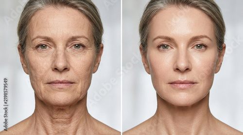 Mature Woman Before and After Skin Rejuvenation, Anti-Aging Treatment