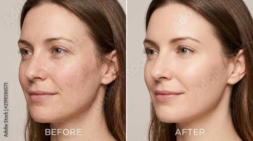 Woman's Skin Before and After Cosmetic Treatment: Wrinkles, Redness, and Hydration