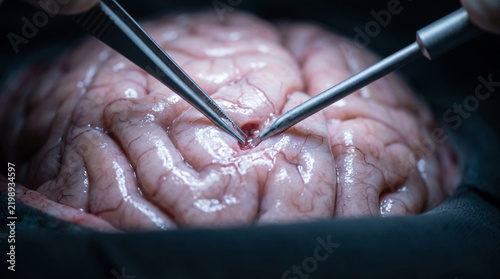 Surgeon performing a delicate brain surgery procedure with medical instruments