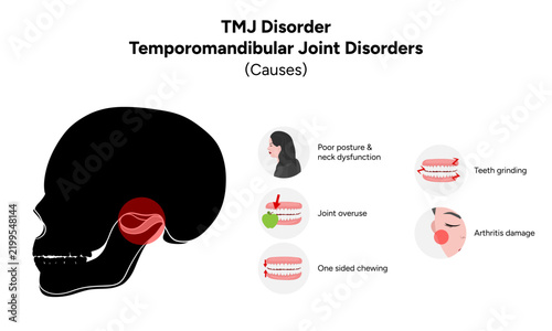 Detailed hand-drawn dental medical illustration explaining the common causes of temporomandibular joint disorder (TMJ disorder). The artwork presents contributing factors such as jaw trauma