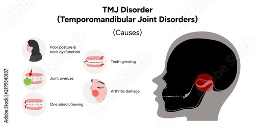 Detailed hand-drawn dental medical illustration explaining the common causes of temporomandibular joint disorder (TMJ disorder). The artwork presents contributing factors such as jaw trauma