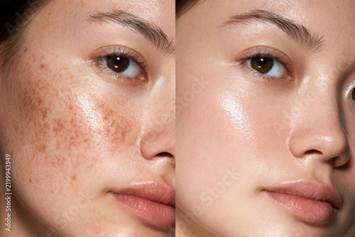 Woman's face with hyperpigmentation before and after a cosmetic skincare treatment