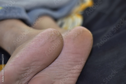 Canvastavla someone's heel is cracked