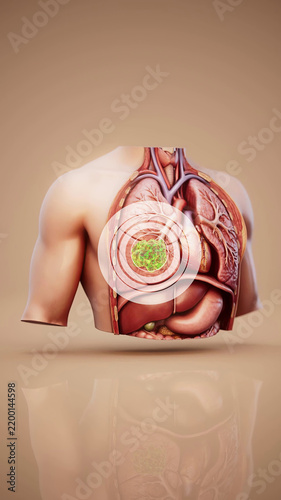 Conceptual 3D illustration of lung cancer and tumor growth in the lungs