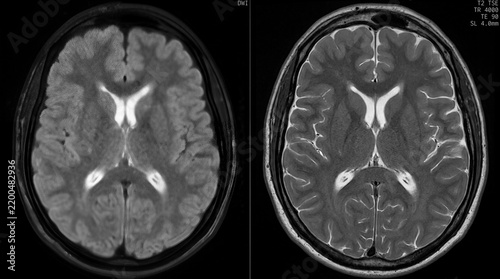 Quadro su tela DWI pair MRI scan of the brain for stroke and ischemia diagnosis