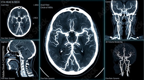 CT angiography scan of head and neck