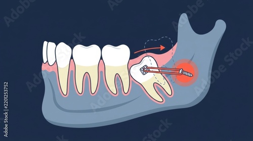 Orthodontic illustration showing a molar tooth being uprighted with a temporary anchorage device