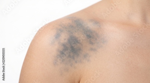Close up of a large dark blue bruise, subcutaneous hemorrhage, or mongolian spot on a woman's shoulder.