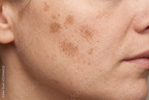 Close-up view of woman cheek with post-inflammatory hyperpigmentation and skin dark spots after healed acne