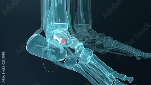 Rotating feet rendering revealing left heel on dark teal studio, showing red suture, heel pad