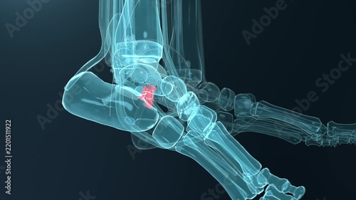 Camera panning showing xray foot bones rotating and zooming in medical render revealing red implant