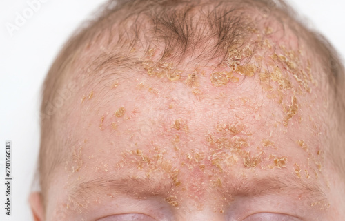 Close up of infantile seborrheic dermatitis cradle cap with crusty yellow scales on baby forehead