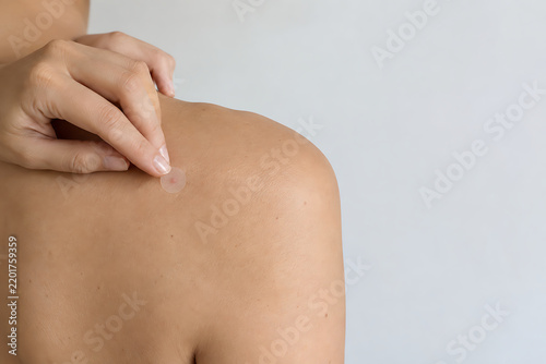 Naklejka Applying acne patch on upper back skin