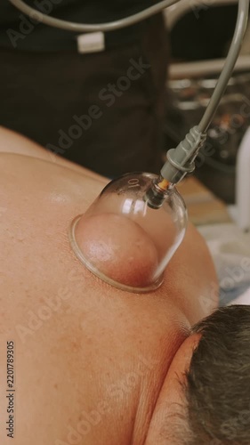 hand holds transparent cupping cup on bare upper back, suction forms raised skin dome with mild redness softly