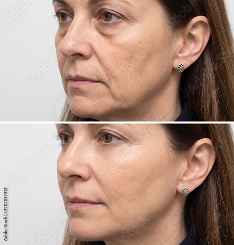 Mature Woman Face Before and After Anti-Aging Skincare Comparison