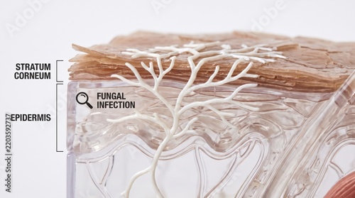 Cross-sectional model of human skin showing the stratum corneum and epidermis with fungal infection spreading through the layers.