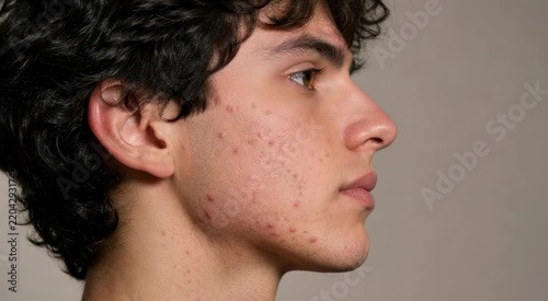Side-profile portrait of a young man with acne and blemished cheek skin against a neutral background