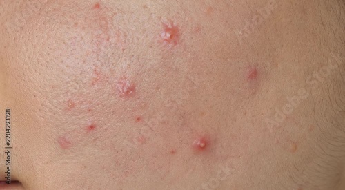 Close-up of a cheek with inflamed acne, red pimples, visible pores and oily skin