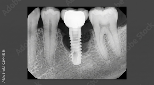 Dental implant radiograph demonstrating bone loss around implant and adjacent roots. Detailed dental imaging shows implant position and surrounding tooth structures.