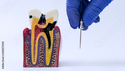 Root canal treatment education concept with dentist hand holding endodontic instrument near anatomical cross section model of decayed tooth.