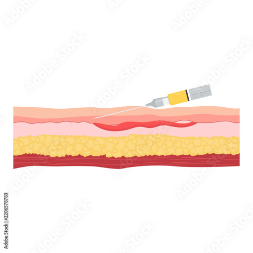 Medical Illustration of intradeermal Injection