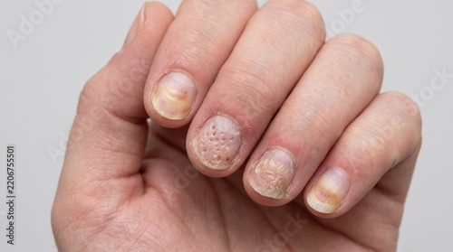 Nail Psoriasis – Pitting, Discoloration and Nail Separation
