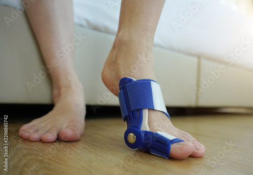 Woman wearing a blue hallux valgus splint as part of a self-care recovery routine at home
