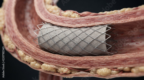 Aortic stent graft inside diseased vessel with plaque buildup, illustrating minimally invasive vascular treatment and restored blood flow through narrowed artery