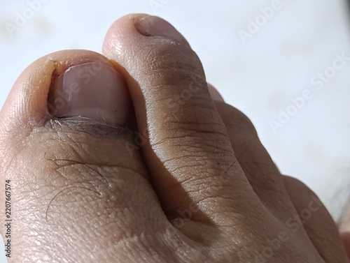 Close-up of human toes with visible skin and nails. Harsh sunlight creates distinct shadows and highlights on foot.