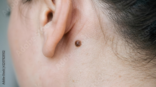 Close up of a human ear with a brown mole on the neck