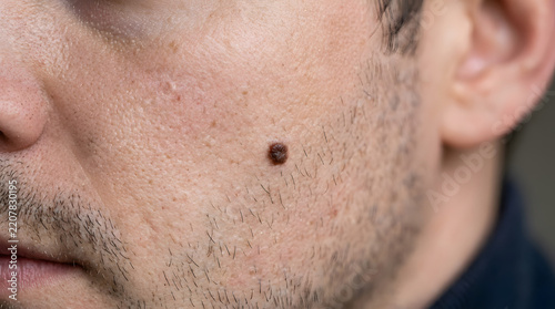 Close-up shot of a man's face, focusing on a dark mole on his cheek. The skin shows a few pores and stubble, with shallow depth of field