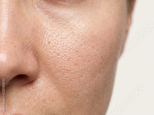 Close Up of Oily Facial Skin With Enlarged Pores and Excess Sebum