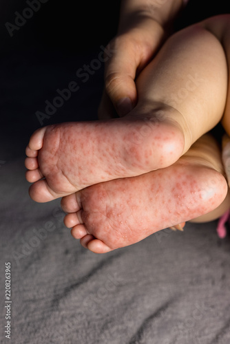 Close up of baby feet affected by hand, foot and mouth disease rash or viral enterovirus infection. Coxsackievirus. Vertical photo.