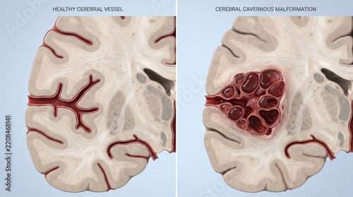 Cerebral Cavernous Malformation Cavernoma Brain Anatomy Comparison
