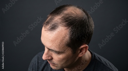 High angle portrait of adult male suffering from crown vertex and receding hairline male pattern baldness