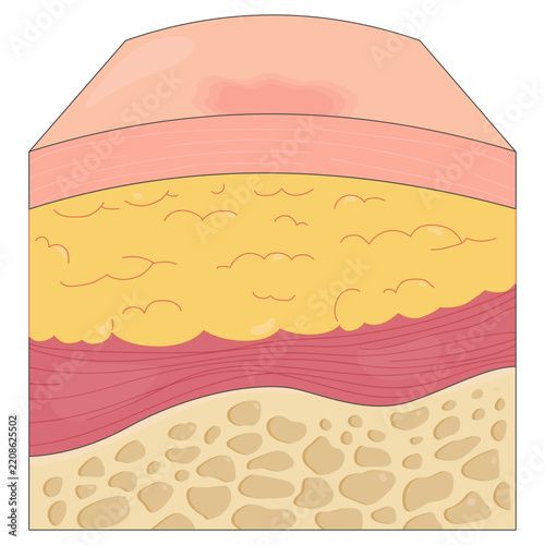 Skin Ulcer Medical Illustrations