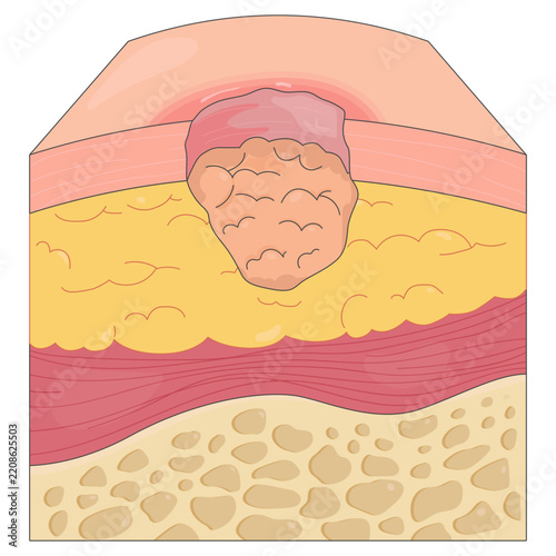 Skin Ulcer Medical Illustrations