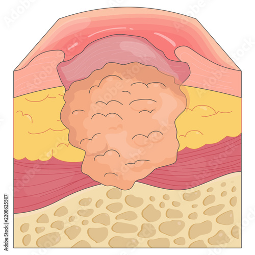 Skin Ulcer Medical Illustrations