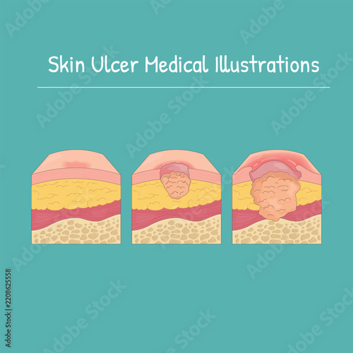 Skin Ulcer Medical Illustrations