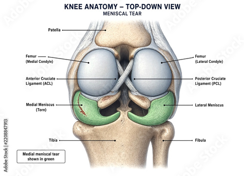 Detailed anatomical diagram of knee showing medial meniscus tear top down view