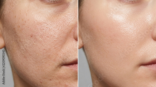 Skin Care Before And After: Pore Reduction & Smooth Complexion