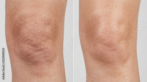 Skin care, dry knee before and after treatment