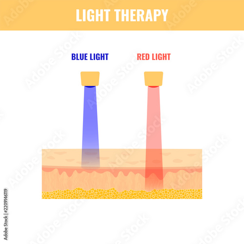 Red and blue light therapy skin cross section with epidermis and dermis beams. Medical vector illustration.
