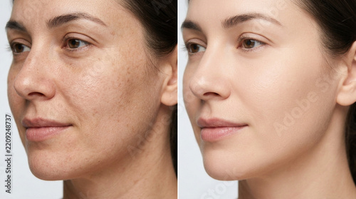 Skin Transformation: Before & After Dark Spots Treatment