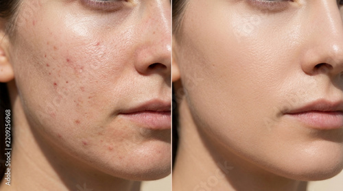 Skin transformation: Before and after foundation application, covering blemishes