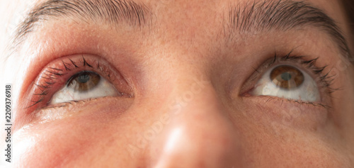 Close-Up of a Middle-Aged Woman with a Swollen Eyelid and Stye