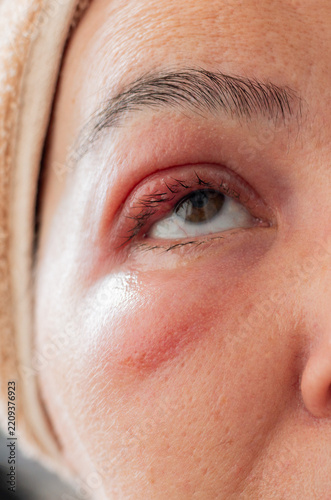 Close-Up of a Middle-Aged Woman with a Swollen Eyelid and Stye