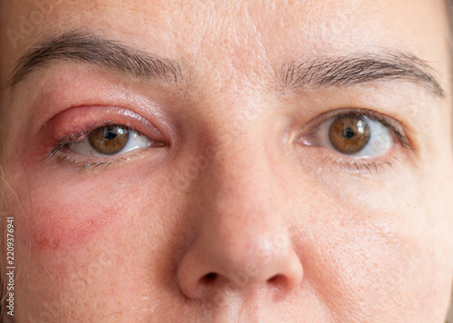 Close-Up of a Middle-Aged Woman with a Swollen Eyelid and Stye